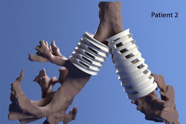 «Четырехмерная» печать спасает жизни картинка «Четырехмерная» печать спасает жизни