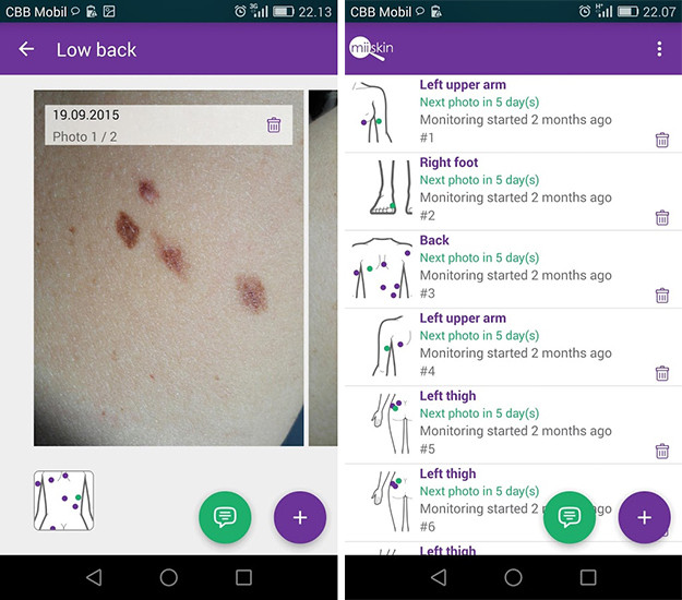 Приложение Miiskin поможет выявить онкологию на ранней стадии картинка Приложение Miiskin поможет выявить онкологию на ранней стадии