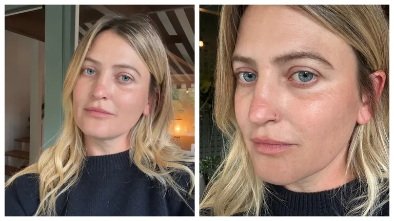 Подтяжка бровей вместо блефаропластики – мой опыт-2