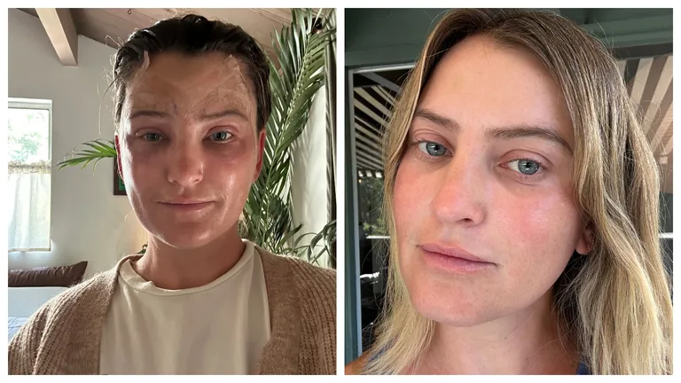 Подтяжка бровей вместо блефаропластики – мой опыт-5