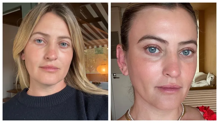 Подтяжка бровей вместо блефаропластики – мой опыт-6